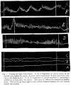 Fig. 2. Tremor of right index-finger.